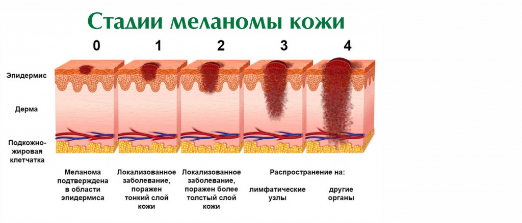 стадии меланомы 1.jpg